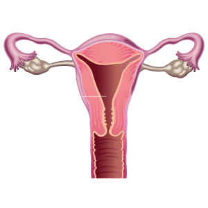 Uterus after UFE procedure - MTVIR