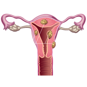 Uterus with fibroids - MTVIR